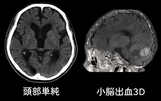 CT検査