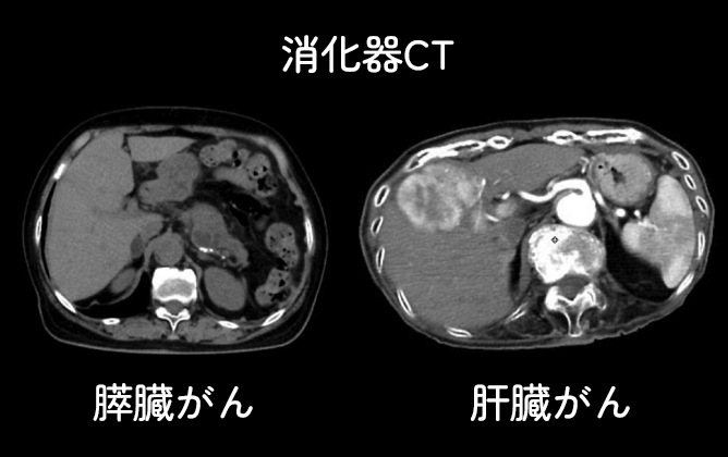 CT検査